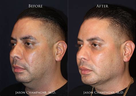 jaw implant vs chin implant
