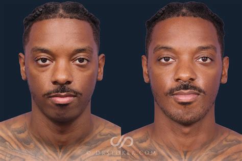 male chin implant before and after