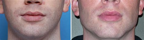 male square chin implant