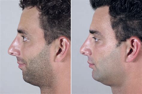 men chin implant