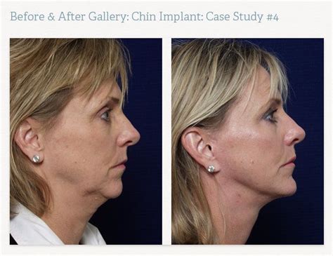 neck lift and chin implant