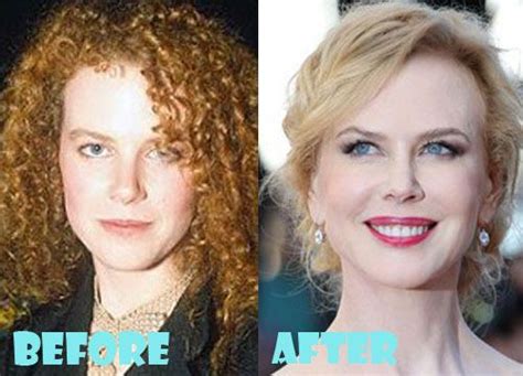 nicole kidman chin implant