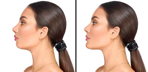 non surgical chin implant cost