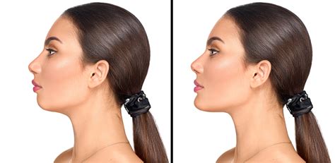 nose job and chin implant