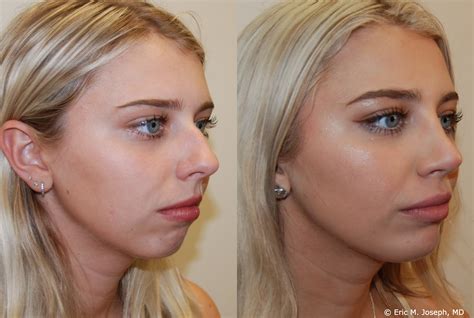 rhinoplasty and chin implant before and after