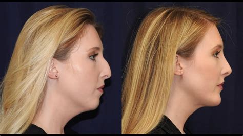 rhinoplasty and chin implant cost