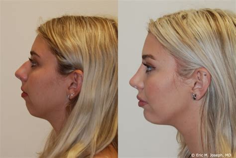 rhinoplasty chin implant before after