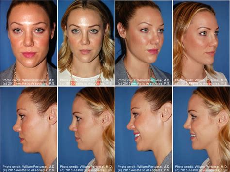 rhinoplasty chin implant