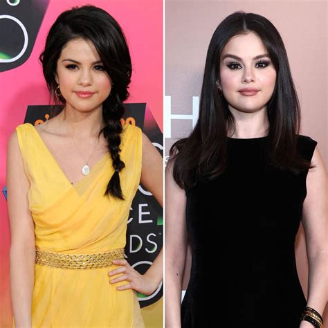 selena gomez chin implant