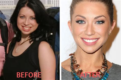 stassi chin implant before and after