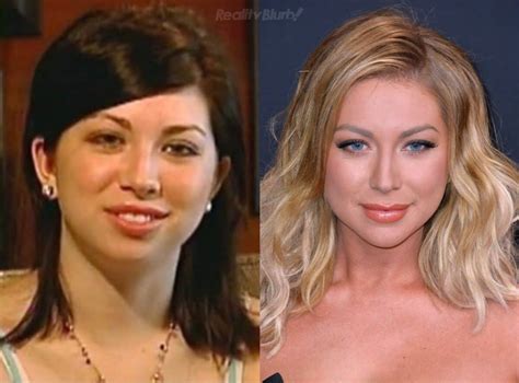 stassie pre chin implant