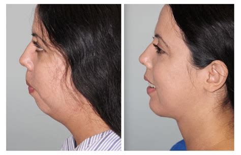 what are chin implants made of