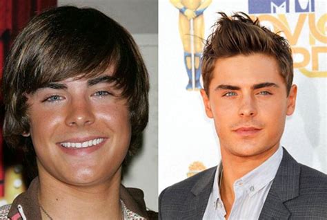 zac efron chin implants